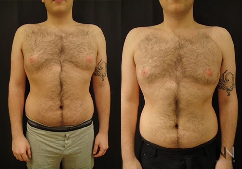 Gynecomastia - Case 1764