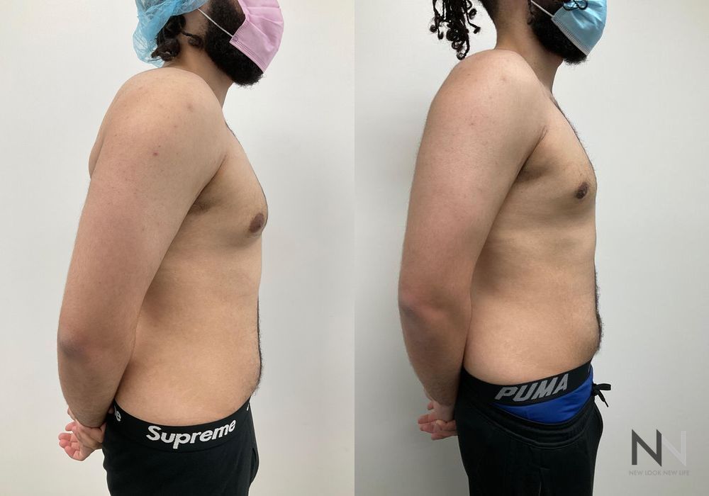 Gynecomastia - Thumbnail 3