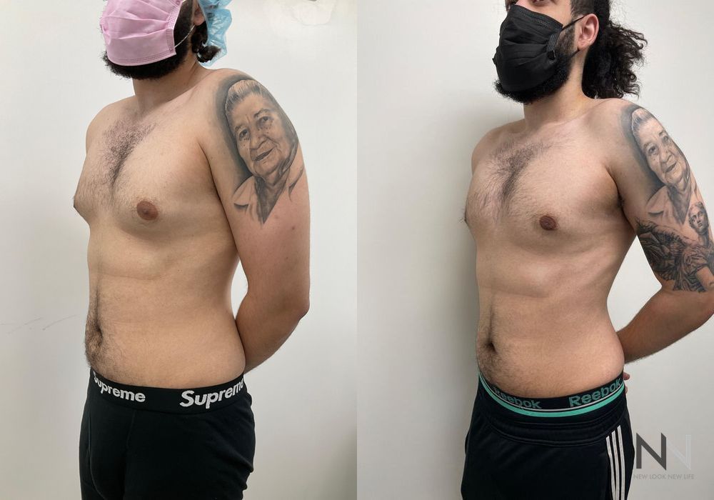 Gynecomastia - Thumbnail 4