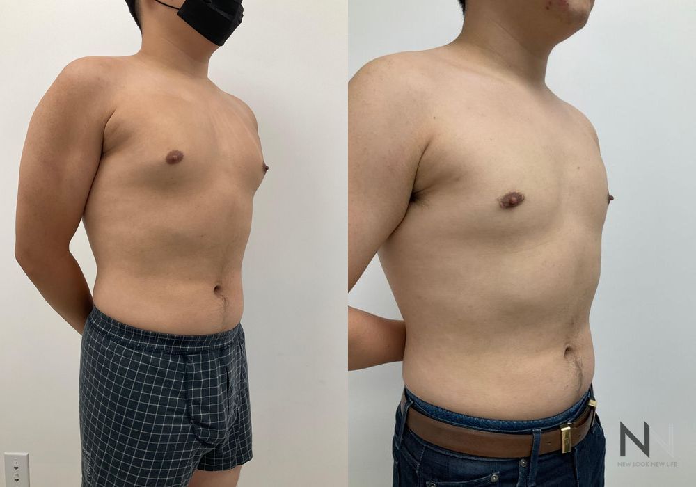 Gynecomastia - Thumbnail 4