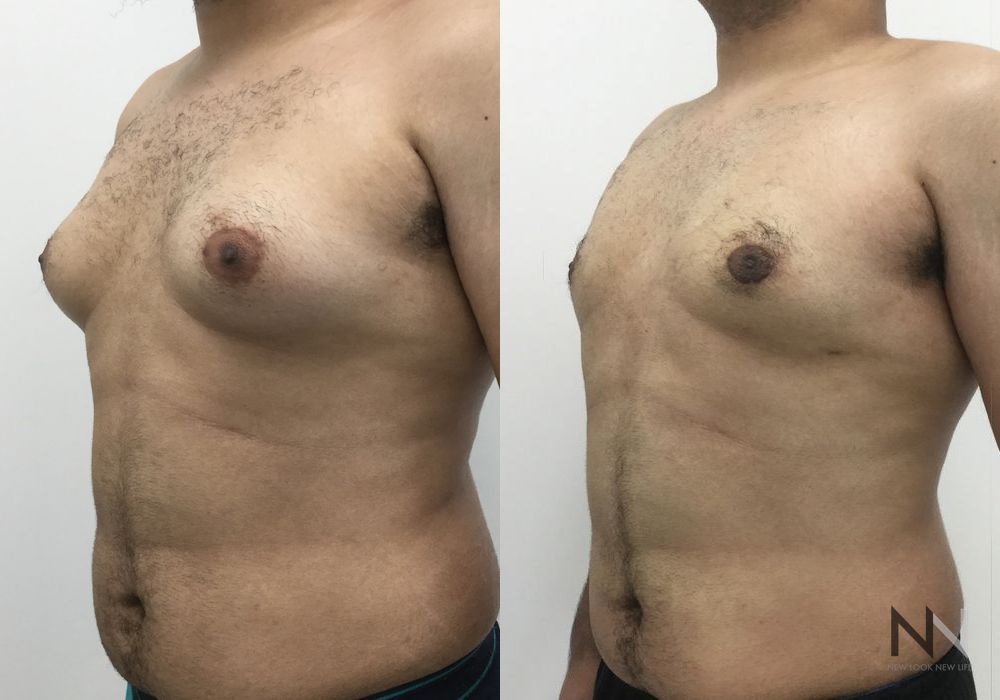 Gynecomastia - Thumbnail 5
