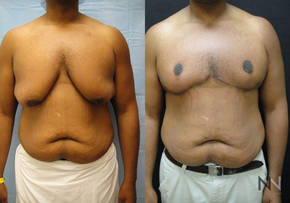 Gynecomastia - Case 1747