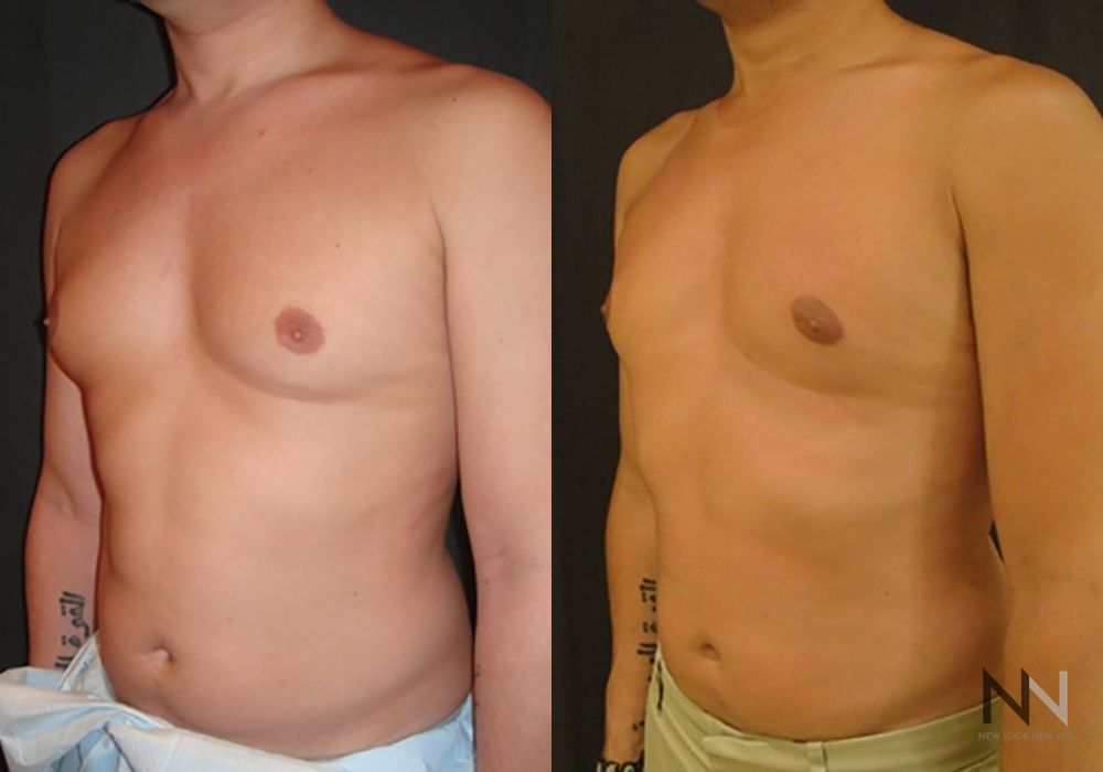 Gynecomastia - Case 1748