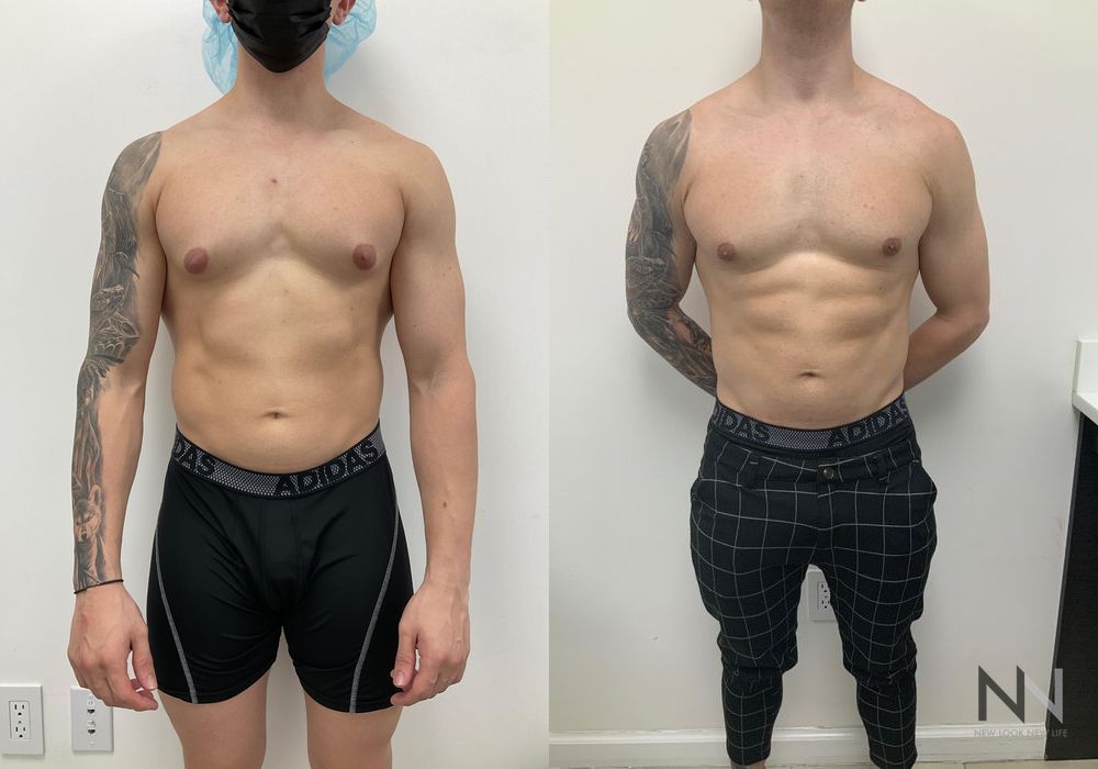 Gynecomastia - Thumbnail 3