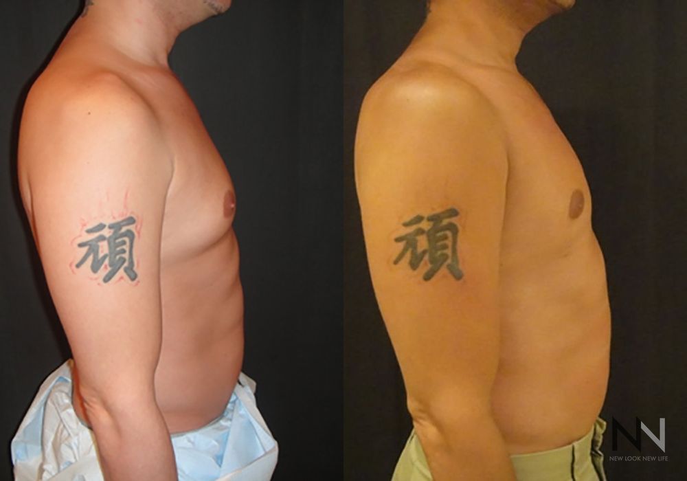 Gynecomastia - Thumbnail 5