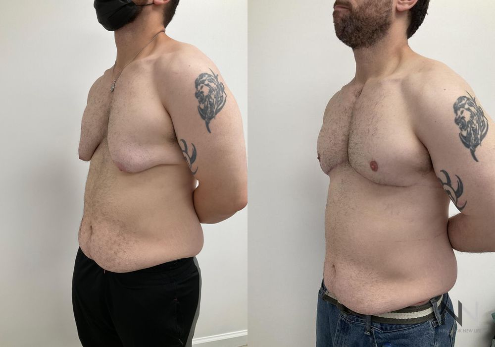 Gynecomastia - Thumbnail 3