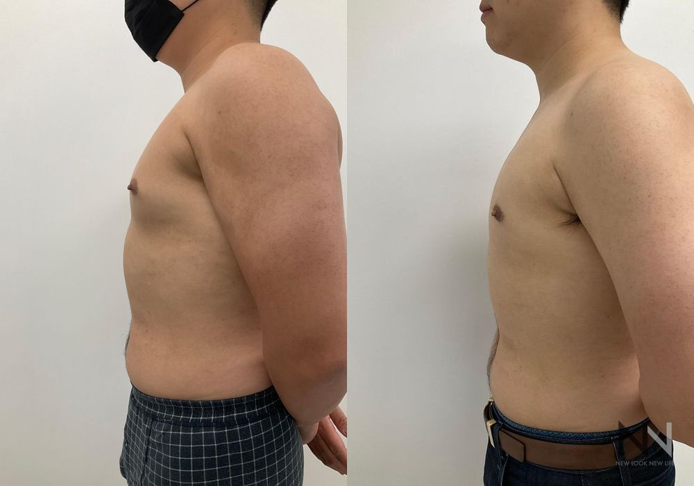 Gynecomastia - Thumbnail 5