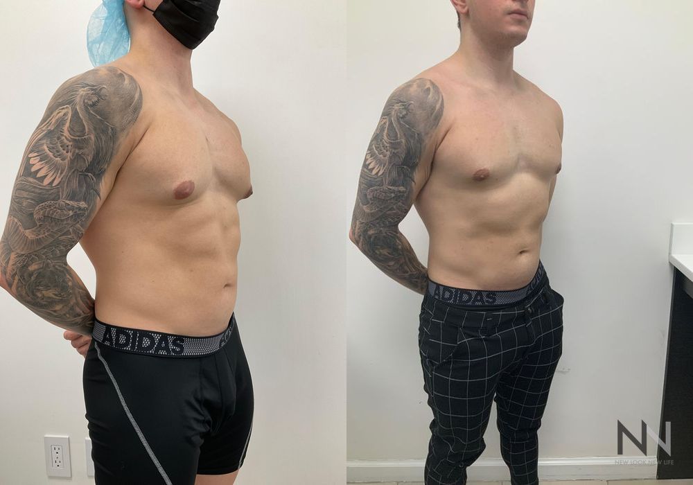 Gynecomastia - Case 1760