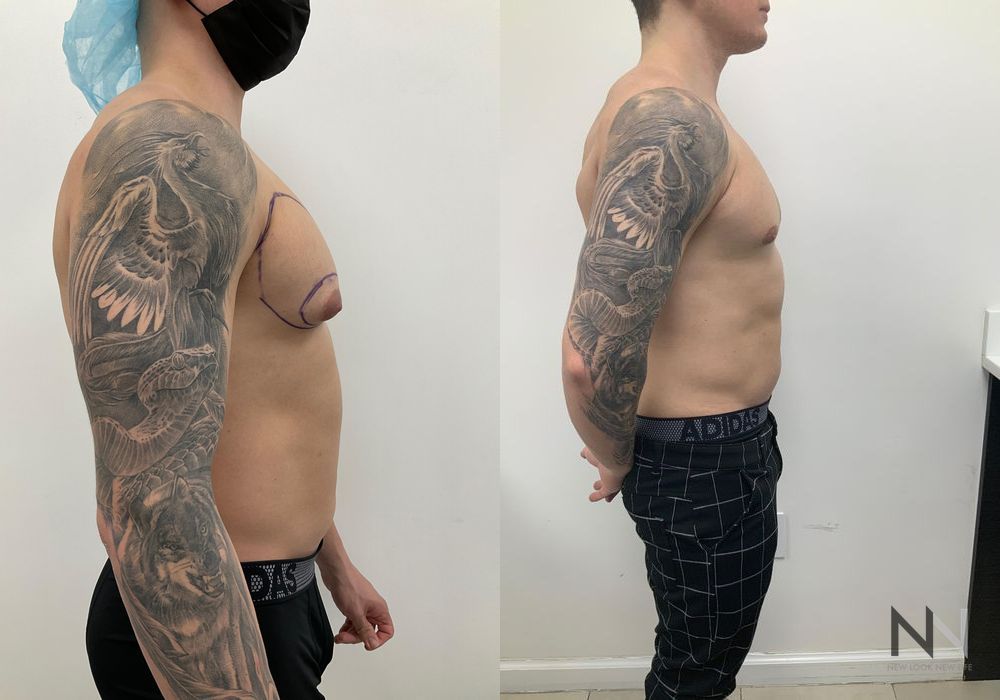 Gynecomastia - Thumbnail 2