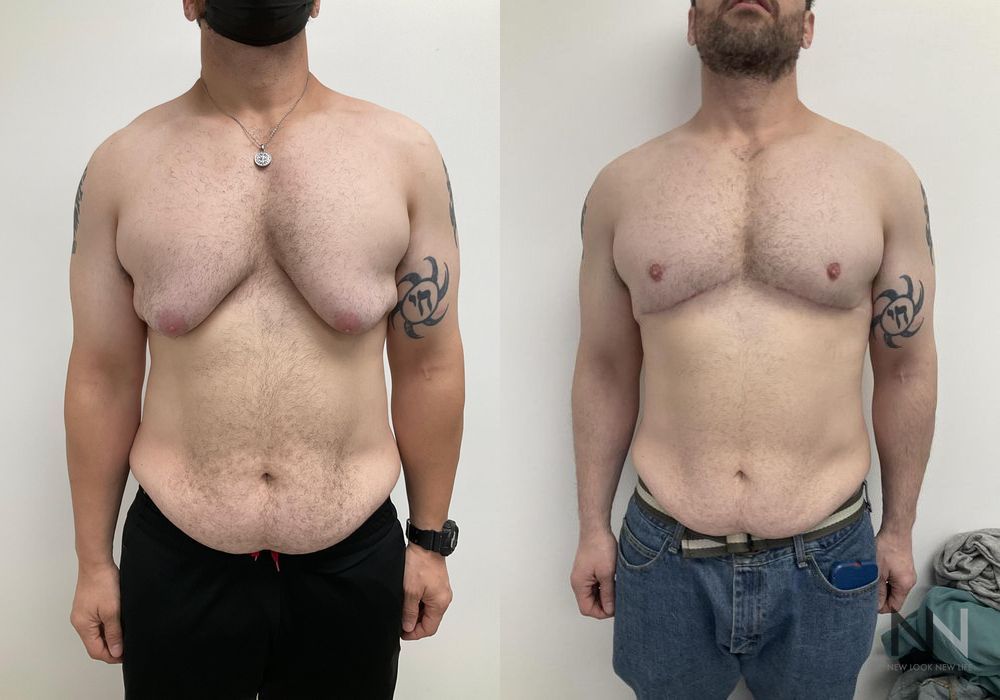Gynecomastia - Case 1763