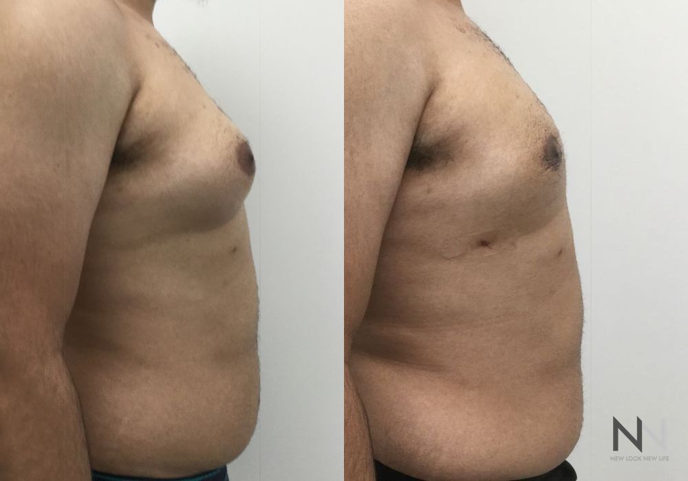 Gynecomastia - Thumbnail 2