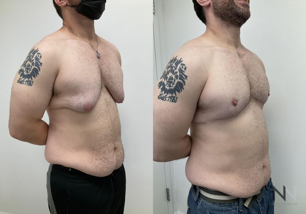 Gynecomastia - Thumbnail 4