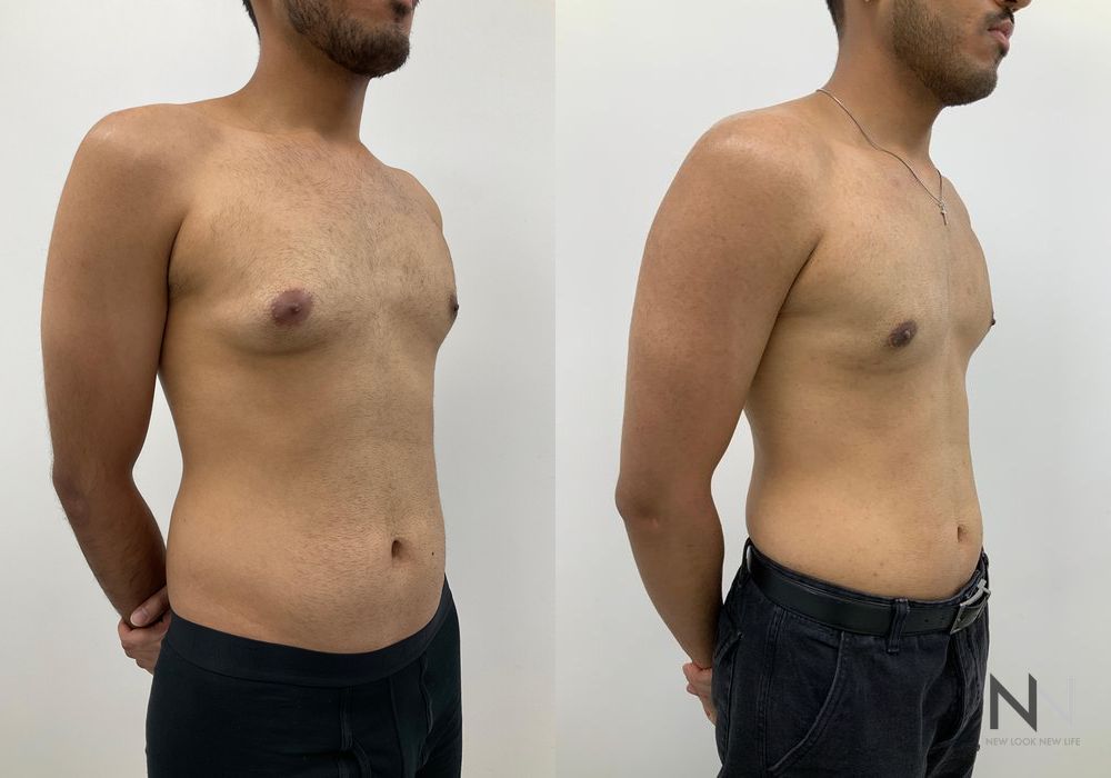 Gynecomastia - Thumbnail 2