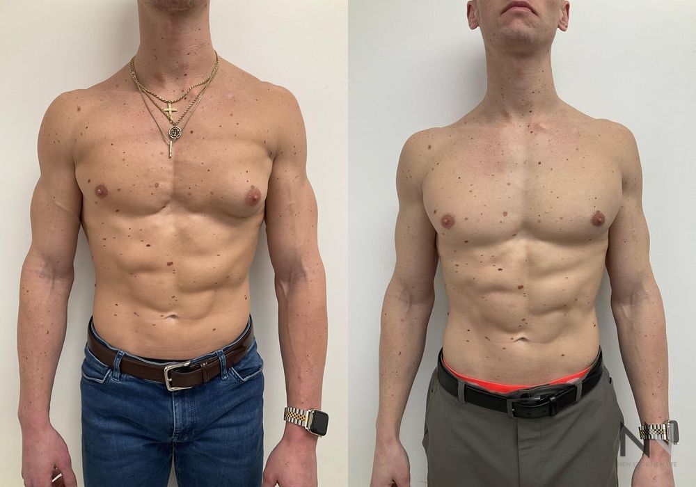 Gynecomastia - Case 1756