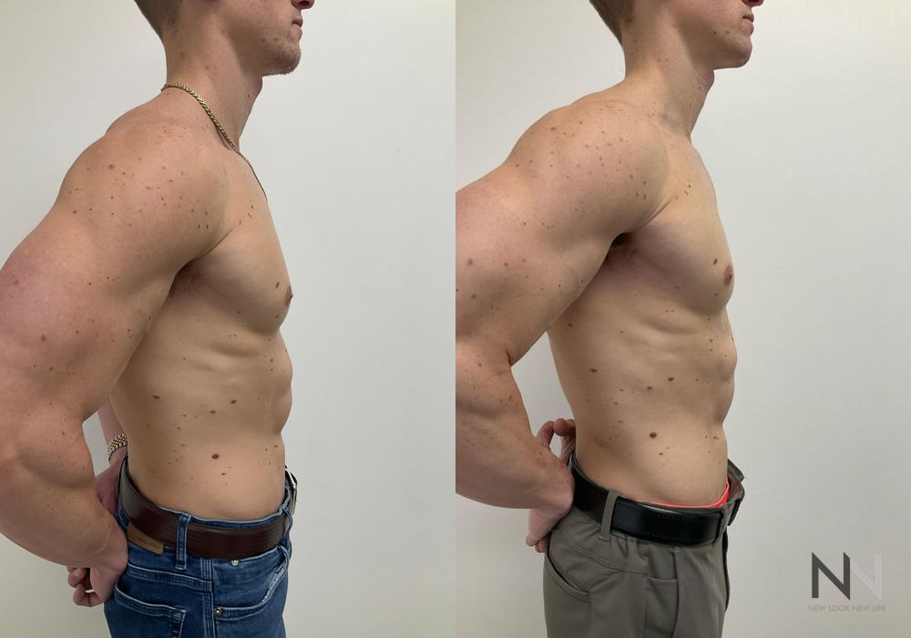 Gynecomastia - Thumbnail 4