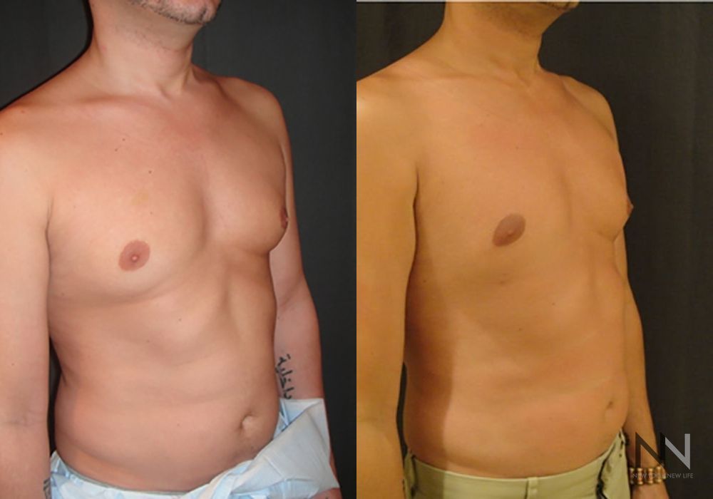Gynecomastia - Thumbnail 4