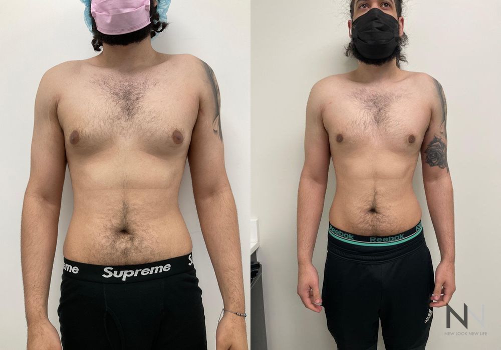 Gynecomastia - Case 2291