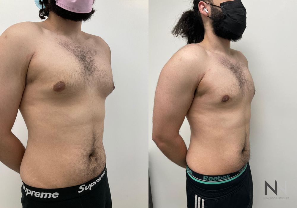 Gynecomastia - Thumbnail 2