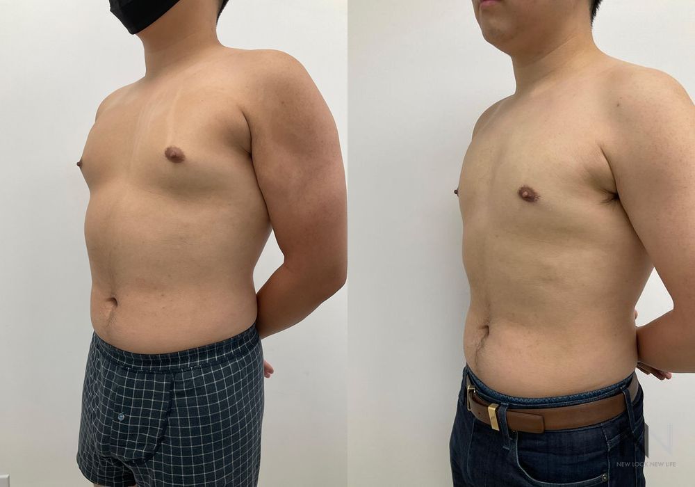 Gynecomastia - Thumbnail 2