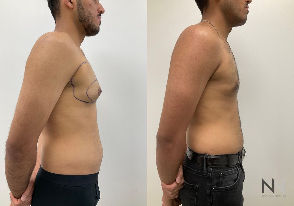 Gynecomastia - Thumbnail 4