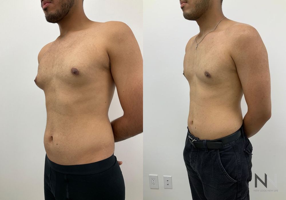 Gynecomastia - Thumbnail 3