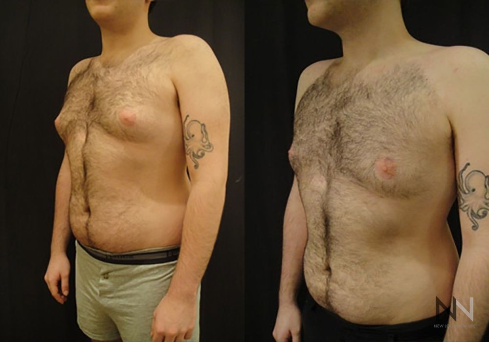 Gynecomastia - Thumbnail 2