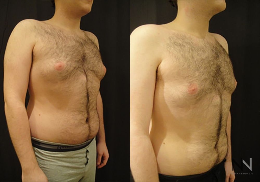 Gynecomastia - Thumbnail 3
