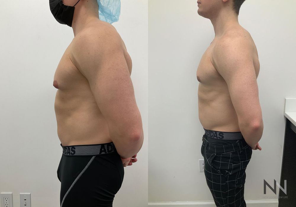 Gynecomastia - Thumbnail 5