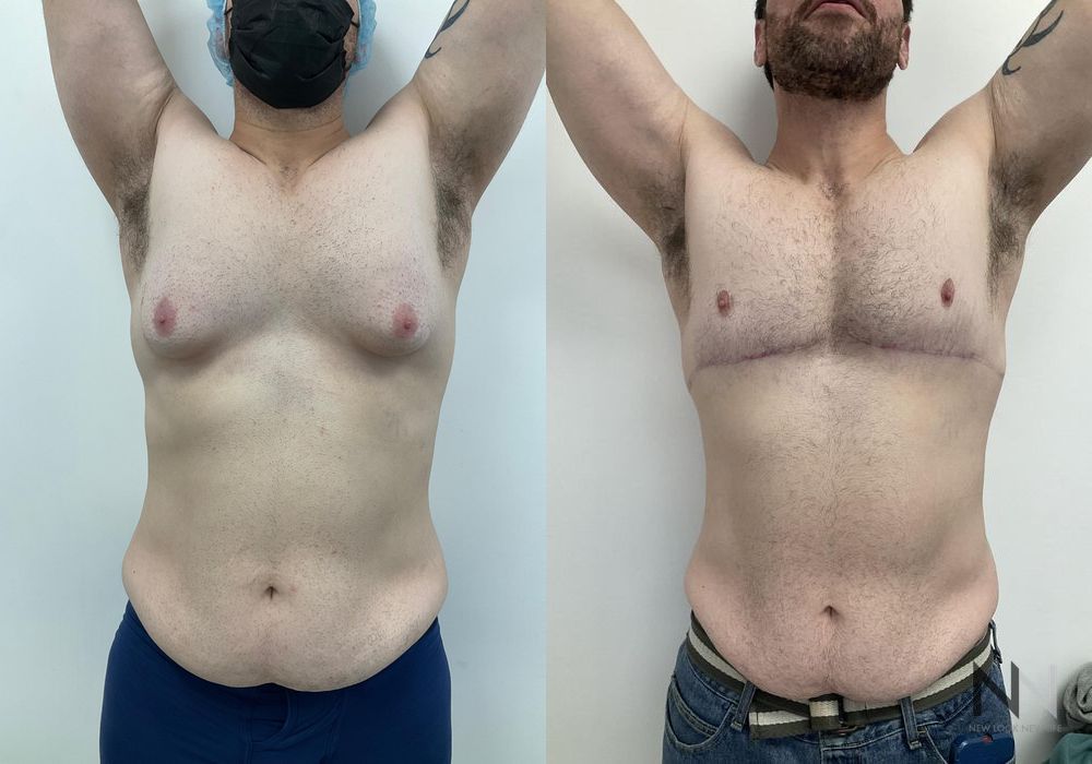 Gynecomastia - Thumbnail 2