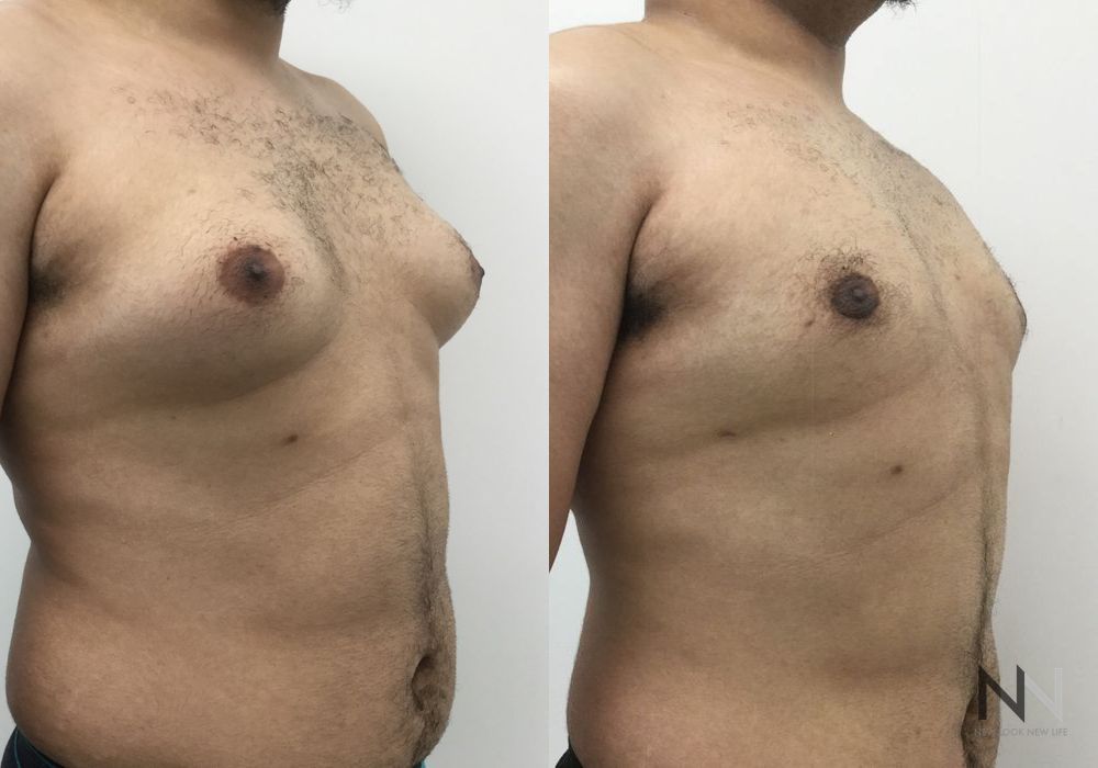 Gynecomastia - Thumbnail 4
