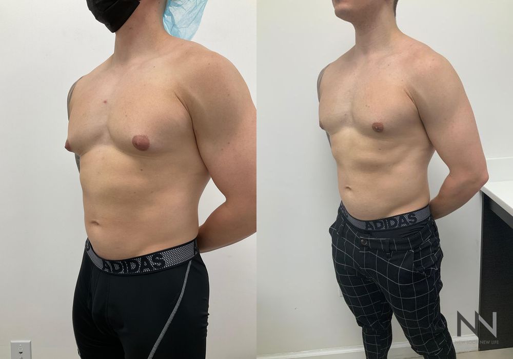 Gynecomastia - Thumbnail 4