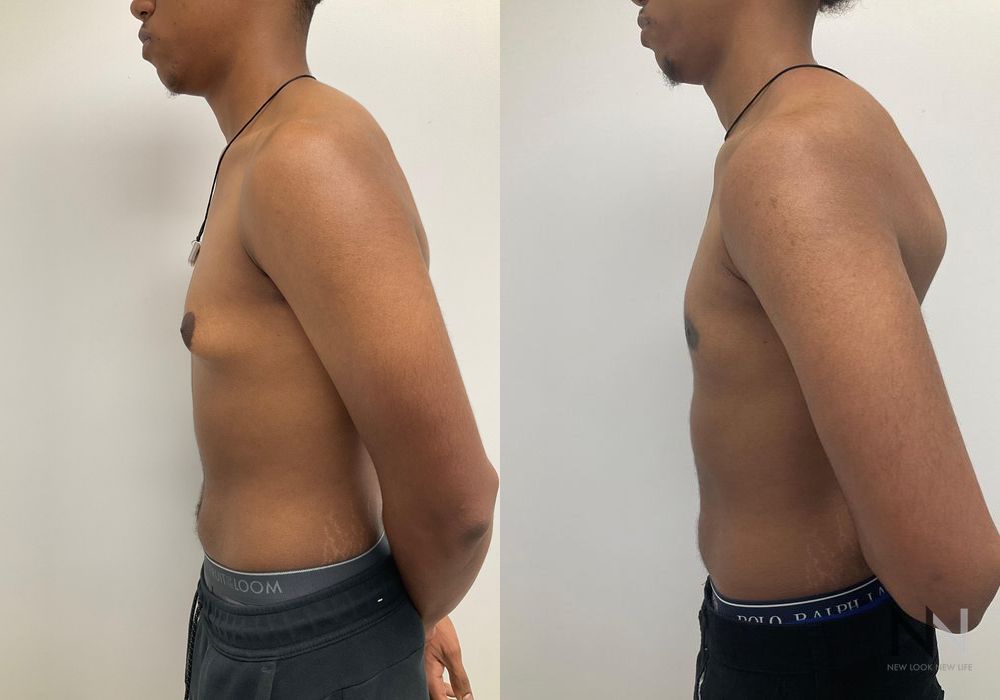 Gynecomastia - Thumbnail 5