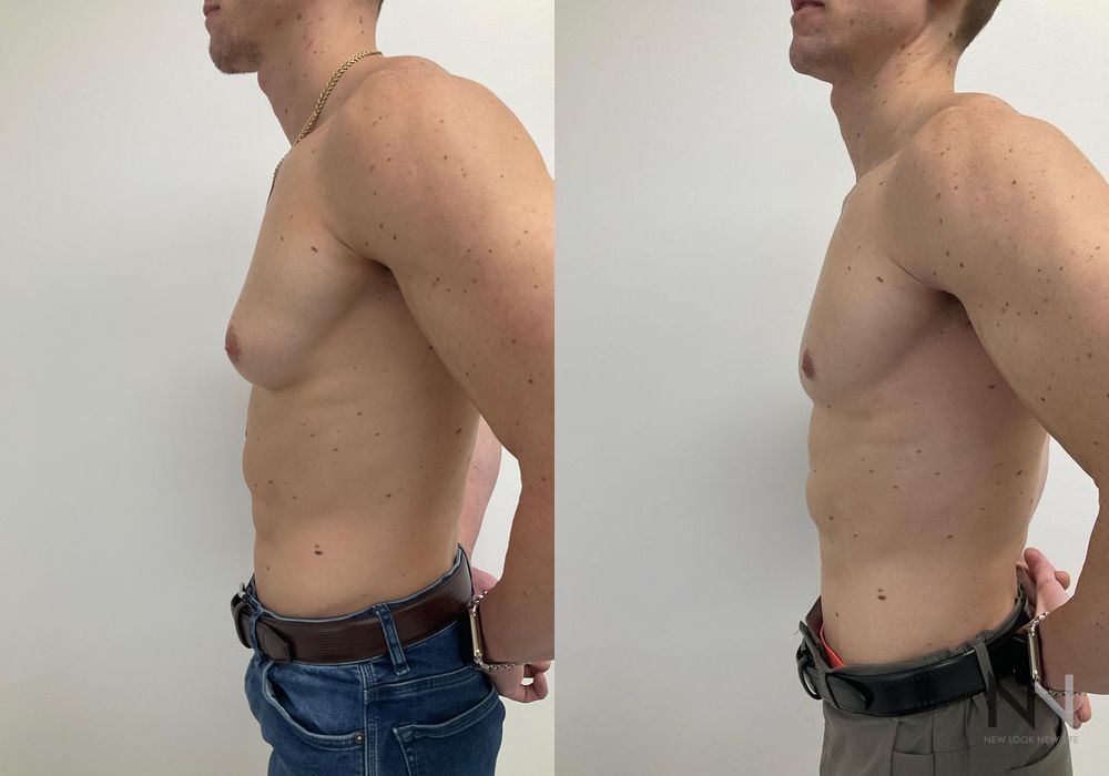 Gynecomastia - Thumbnail 5