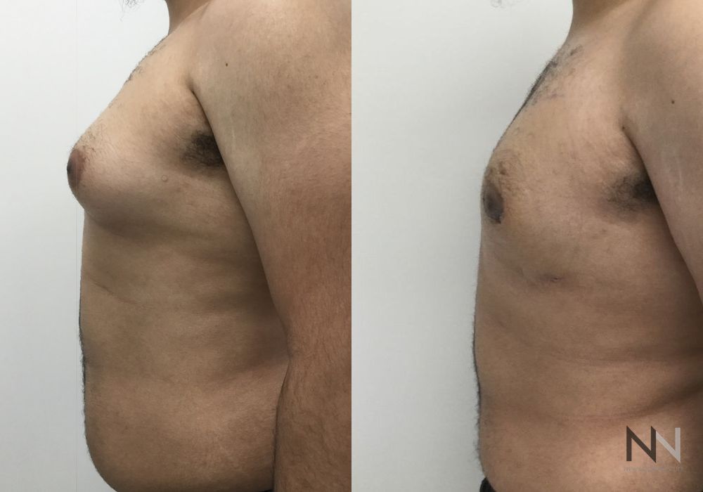 Gynecomastia - Thumbnail 3