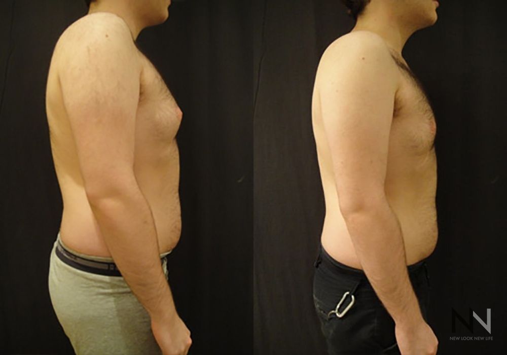 Gynecomastia - Thumbnail 4