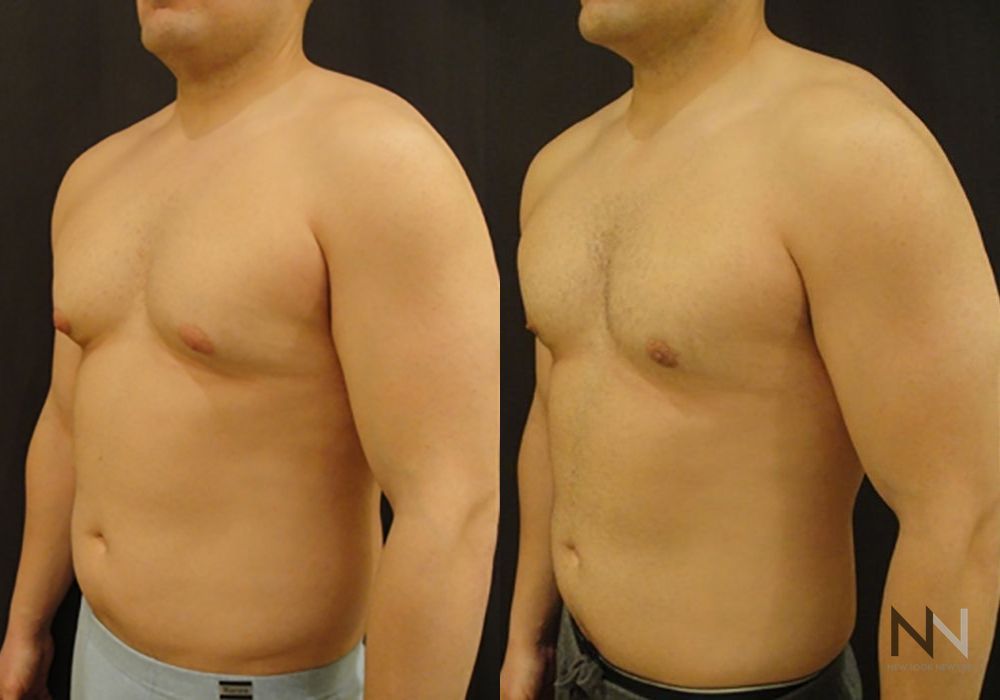 Gynecomastia - Thumbnail 4