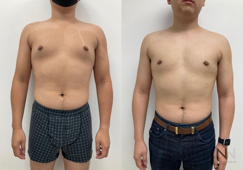 Gynecomastia - Case 1752