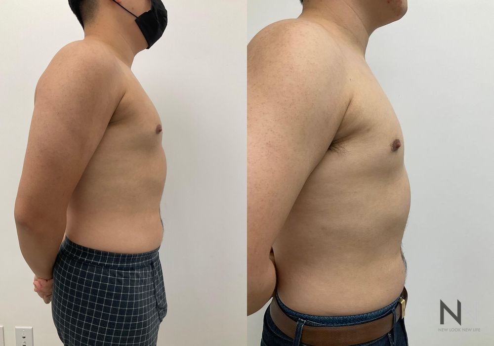 Gynecomastia - Thumbnail 3