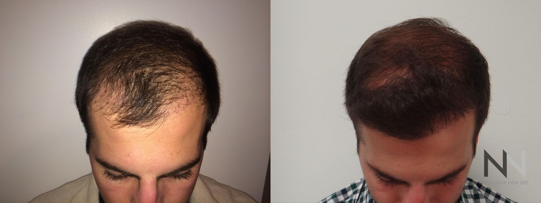 Before and after FUE hair transplant showing crown improvement