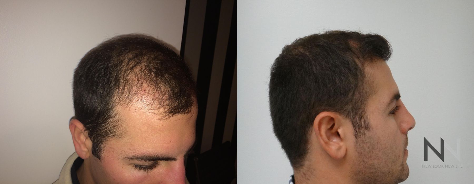 Hair Loss Treatment - Thumbnail 3