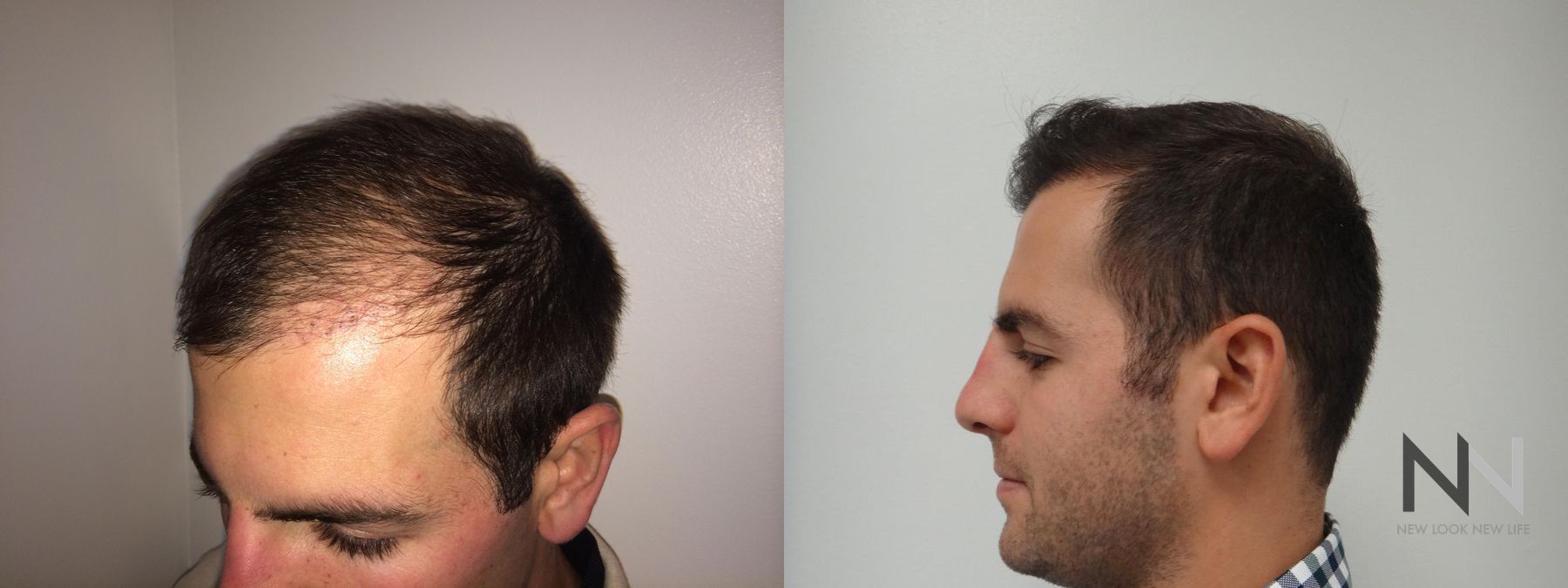 Before and after FUE hair transplant showing crown improvement - Angle 2