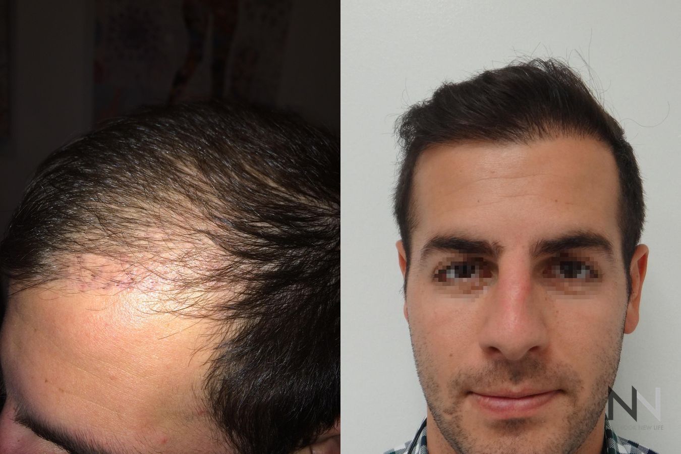 Before and after FUE hair transplant showing crown improvement - Angle 4