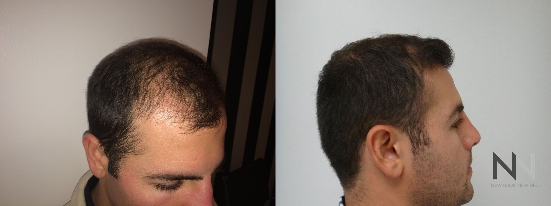 Before and after FUE hair transplant showing crown improvement - Angle 3