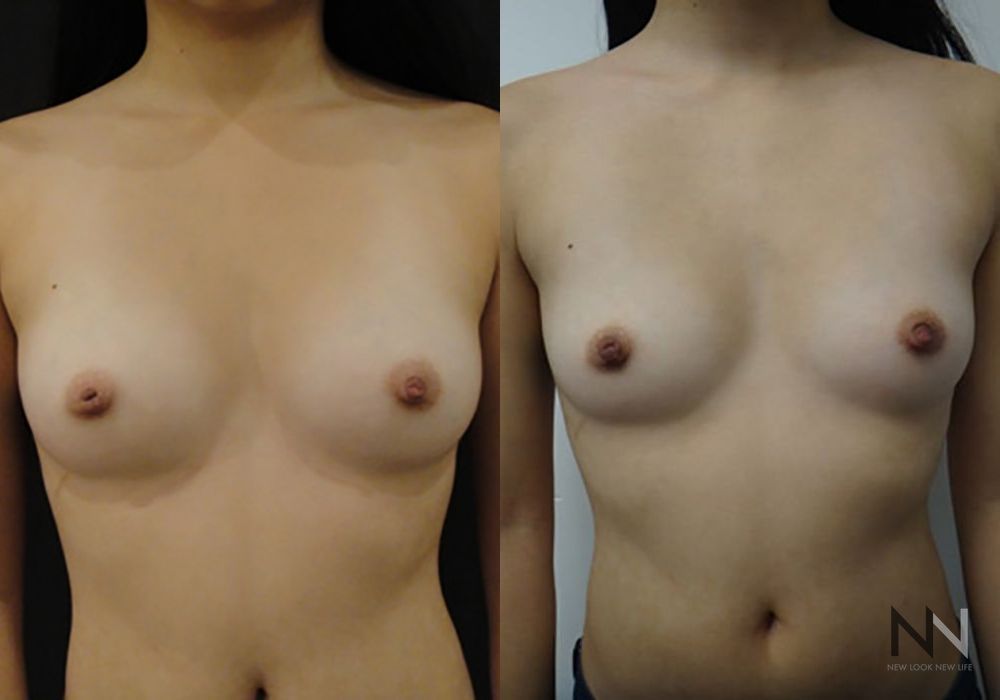 Inverted Nipple Surgery - Case 1870