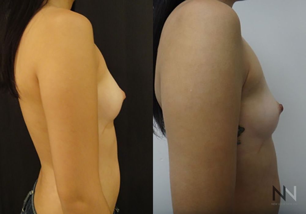 Inverted Nipple Surgery - Thumbnail 5