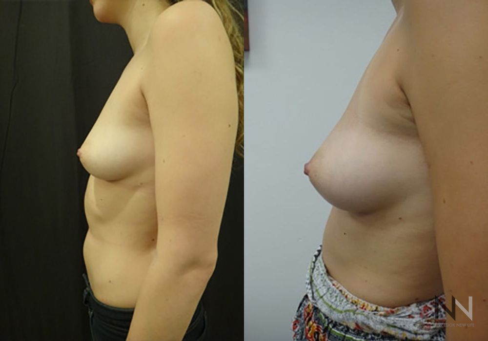 Inverted Nipple Surgery - Thumbnail 5