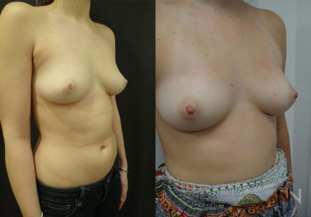 Inverted Nipple Surgery - Thumbnail 2