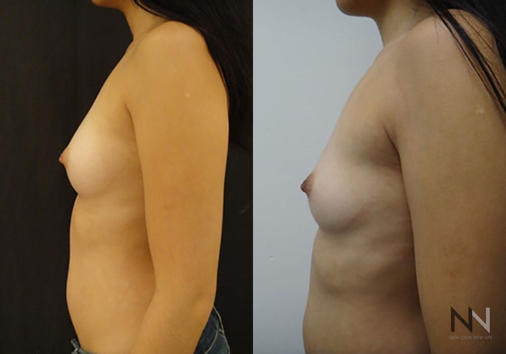 Inverted Nipple Surgery - Thumbnail 4