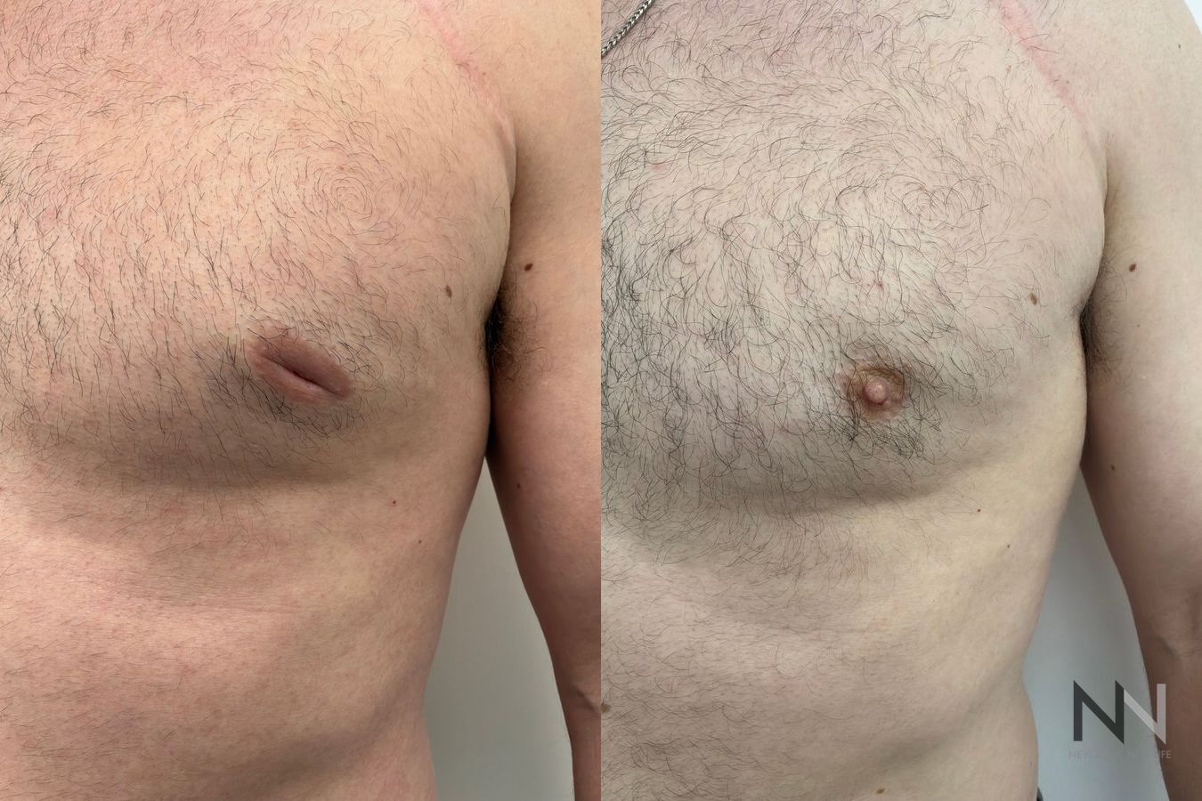 Side-by-side before-and-after photographs of a 37-year-old male patient, showing bilateral inverted nipples before surgery and improved nipple projection after correction.