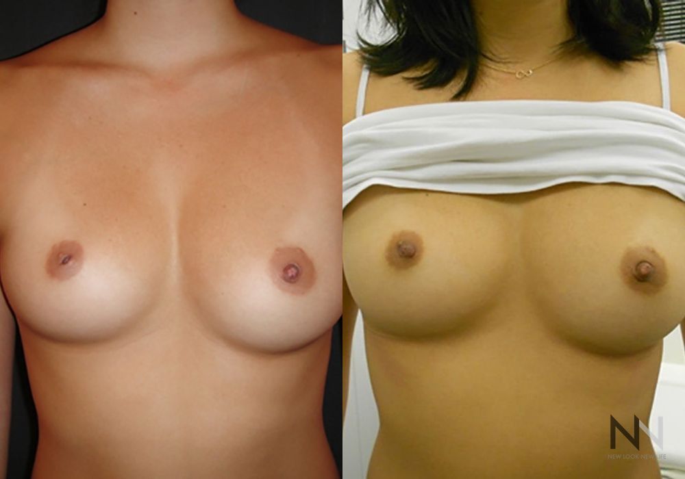 Inverted Nipple Surgery - Case 1869